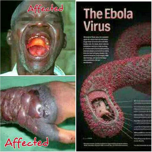 Dịch Ebola: Nguyên nhân, triệu chứng, cách phòng bệnh - 1